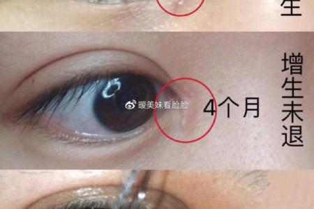 割双眼皮能改变命运密码吗？解密命理中的暗藏玄机